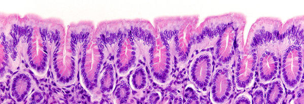 Histologie von Speiseröhrenkrebs